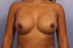 Breast Augmentation Before and after photo