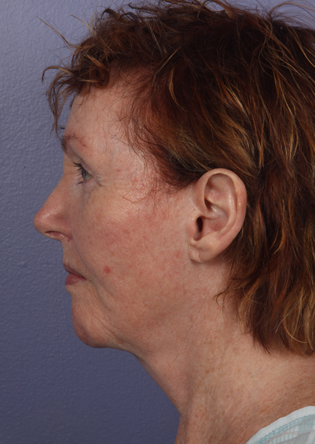 Facelift before and after photo