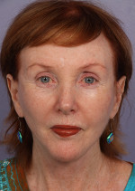 Facelift Before and after photo