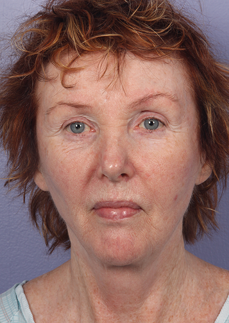 Facelift before and after photo