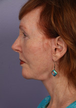 Facelift Before and after photo