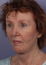 Facelift Before and after photo