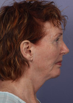 Facelift Before and after photo