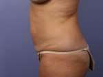 Tummy Tuck Before and after photo