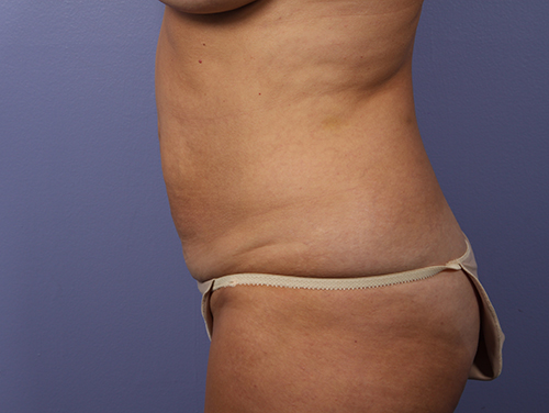 Tummy Tuck before and after photo