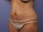 Tummy Tuck Before and after photo