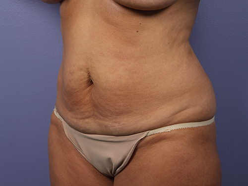 Tummy Tuck before and after photo