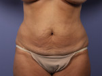 Tummy Tuck Before and after photo