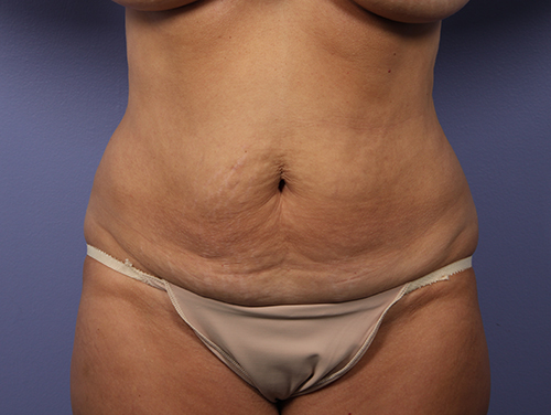 Tummy Tuck before and after photo