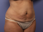 Tummy Tuck Before and after photo