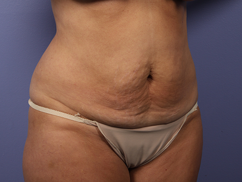 Tummy Tuck before and after photo