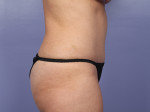 Tummy Tuck Before and after photo