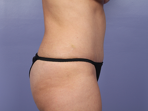 Tummy Tuck before and after photo