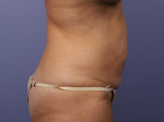 Tummy Tuck Before and after photo