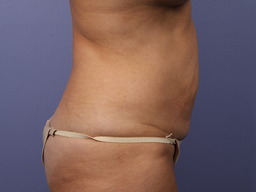 Tummy Tuck before and after photo