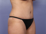 Tummy Tuck Before and after photo