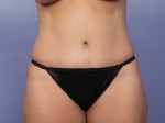 Tummy Tuck Before and after photo