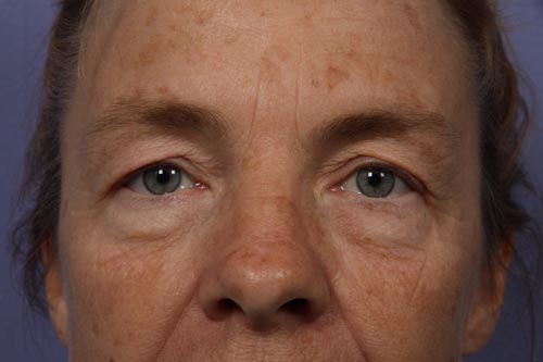 Eyelid Surgery before and after photo