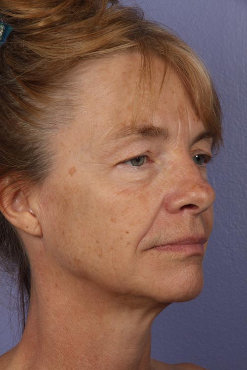 Eyelid Surgery before and after photo