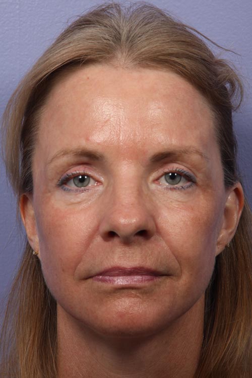 Eyelid Surgery before and after photo