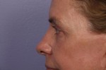 Eyelid Surgery Before and after photo