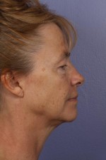 Eyelid Surgery Before and after photo