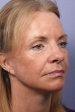 Eyelid Surgery Before and after photo