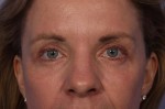 Eyelid Surgery