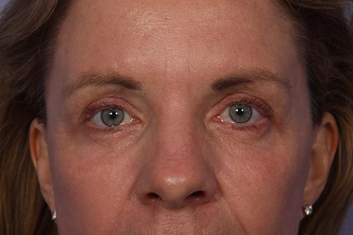 Eyelid Surgery before and after photo