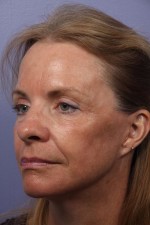 Eyelid Surgery Before and after photo