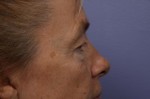 Eyelid Surgery Before and after photo