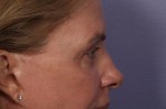 Eyelid Surgery