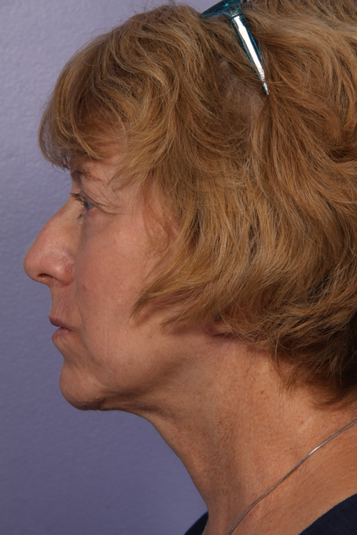 Facelift before and after photo