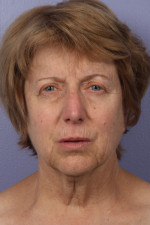 Facelift Before and after photo