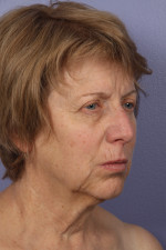 Facelift Before and after photo