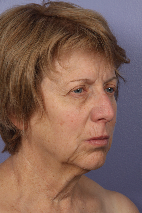 Facelift before and after photo