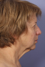 Facelift Before and after photo