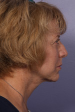 Facelift Before and after photo