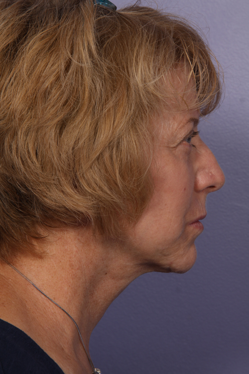 Facelift before and after photo