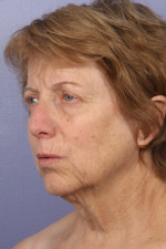 Facelift Before and after photo