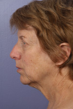 Facelift Before and after photo