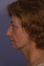 Facelift Before and after photo