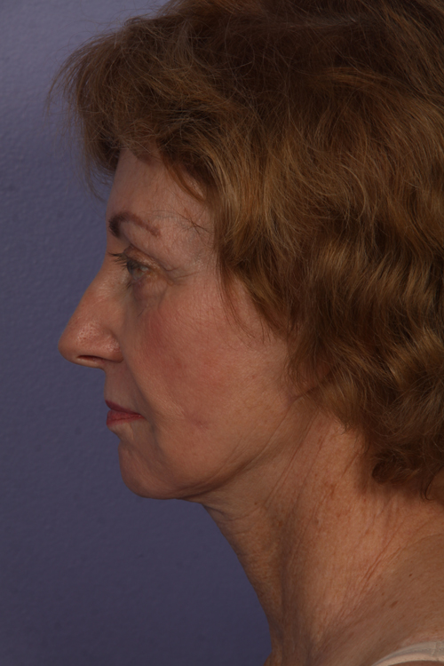 Facelift before and after photo