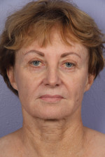 Facelift Before and after photo