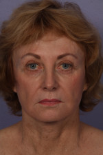 Facelift Before and after photo