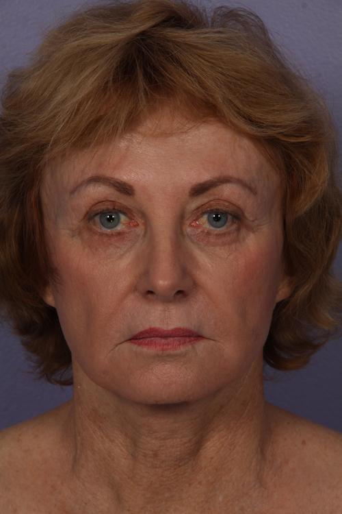 Facelift before and after photo