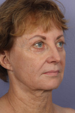 Facelift Before and after photo