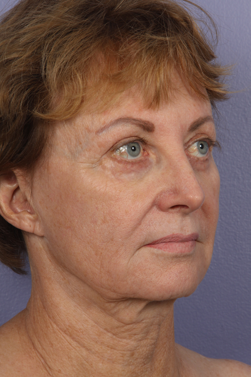 Facelift before and after photo