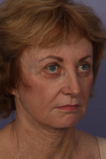 Facelift Before and after photo