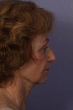 Facelift Before and after photo